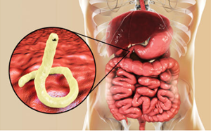 BỆNH NHIỄM GIUN MÓC VÀ NHỮNG ĐIỀU CẦN BIẾT